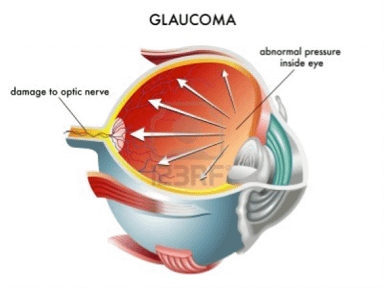 Affrontare il glaucoma in modo efficace